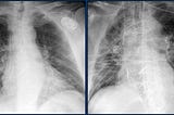 Covid 19 Chest X Ray Classification using Transfer Learning and KNN Classifier