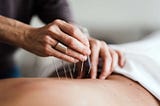 Acupuncture Treatment in St. Pete