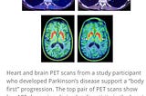 A series of ultrahigh-resolution brain Positron Emission Tomography images has been selected as the…