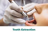Tooth Extraction — Dental Panache