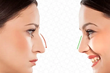 Mastering The Art Of Nose Thread Lift: Benefits, Risks, And Expert Insights!