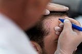 Hair Transplant Methods: Synthetic vs. Natural — Which is Right for You?