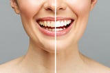How Long Does Teeth Whitening by a Specialist Last?