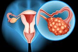 Ovarian Cancer Treatment in India