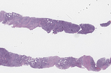 NPM1-Mutated Myeloid Sarcoma