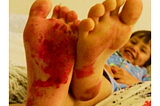 Young child giggling showing the soles of his feet covered in red nail polish.