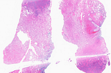 EBV+ DLBCL with LYG Features