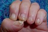 Catch Nail Fungus