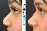 Nose Reshaping