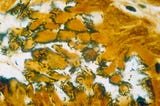 Microscope image of human epithelial cells (yellow) being swarmed by S-shaped bacteria (silver)