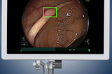 FDA Approves First AI Tool for Detecting Colorectal Polyps