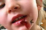 Olivia Farnsworth busted lip. Meet Olivia Farnsworth the worlds only true Superhuman.