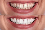 Top 10 Benefits of Teeth Whitening