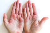 Eczema & Dishwashing: Solution For Managing Sensitive Skin