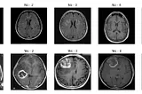 Brain Tumor Detection Using VGG16: An Approach with MRI Image Analysis