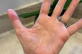 My palmar rash reminiscent of syphilis, scabies and other scourges.