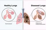 Your Smoker´s Lungs cannot Be Used for Research although You are a 3- Decade-Smoker Without Health…