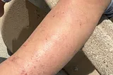 Let’s Learn About Eczema