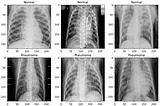 Building a Pneumonia Detection Model with Transfer Learning