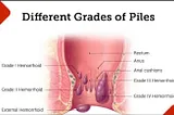 Piles disease