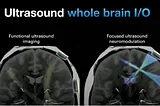 Neurotech 2024 is exciting (ultrasound implants)