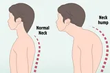 Understanding and Reversing Neck Hump: Causes, Treatments, and Effective Exercises