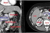 How to Segment a Pancreas CT