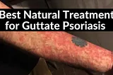 Best Natural Treatment for Guttate Psoriasis that Works