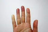 Thawing the Ice: A Raynaud’s Survivor’s Guide to Toasty Hands