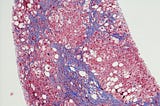 The Nobel Prize Is a Reminder of Hepatitis C’s Dark History