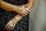 A close up of a woman’s arms and hands with vitiligo.