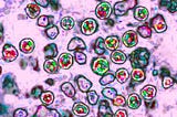 What You Need to Know About Measles