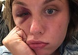 I Got a Black Eye and It Taught Me a Thing or Two About Sexism
