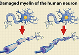 mRNA Vaccine Caused Multiple Sclerosis in Case Report: Putting Things in Perspective