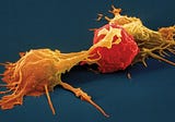 “Empowering the Fight Against Ovarian Cancer: The Role of Natural Killer Cells Unveiled”