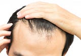 The Ultimate Guide to Regrowing a Receding Hairline