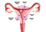 Uterine Fibroids: spreading awareness