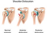 A Formerly Dislocated Shoulder