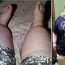 Doctors Told Me I Was ‘Just Fat’ — My Serious Medical Condition Was Missed