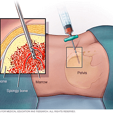 Advantages of Mobilized Stem Cells vs. Bone Marrow Stem Cells | Astarte Biologics