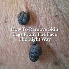 Removing Skin Tags From The Face
