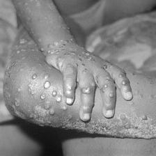 Coliopox — There Is No Cure For The Virus of Stupidity That Got Us Here