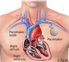 Learn About Pacemakers Implant In The Next 60 Seconds
