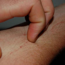 Acute itching in eczema patients linked to environmental allergens
