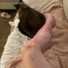 Biologics for Psoriasis with Least Side Effects ?