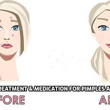 Acne Treatment & Medication for Pimples and Blackheads