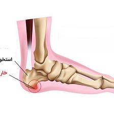 همه چیز درباره خار پاشنه