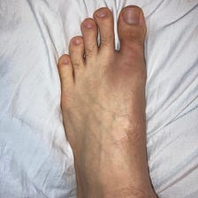 Natural Bunion Reversal in 5 Steps