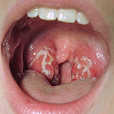 Tonsillitis — What is it & How Can it be Treated?
