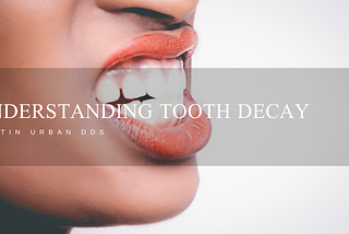 Understanding Tooth Decay | Martin Urban DDS